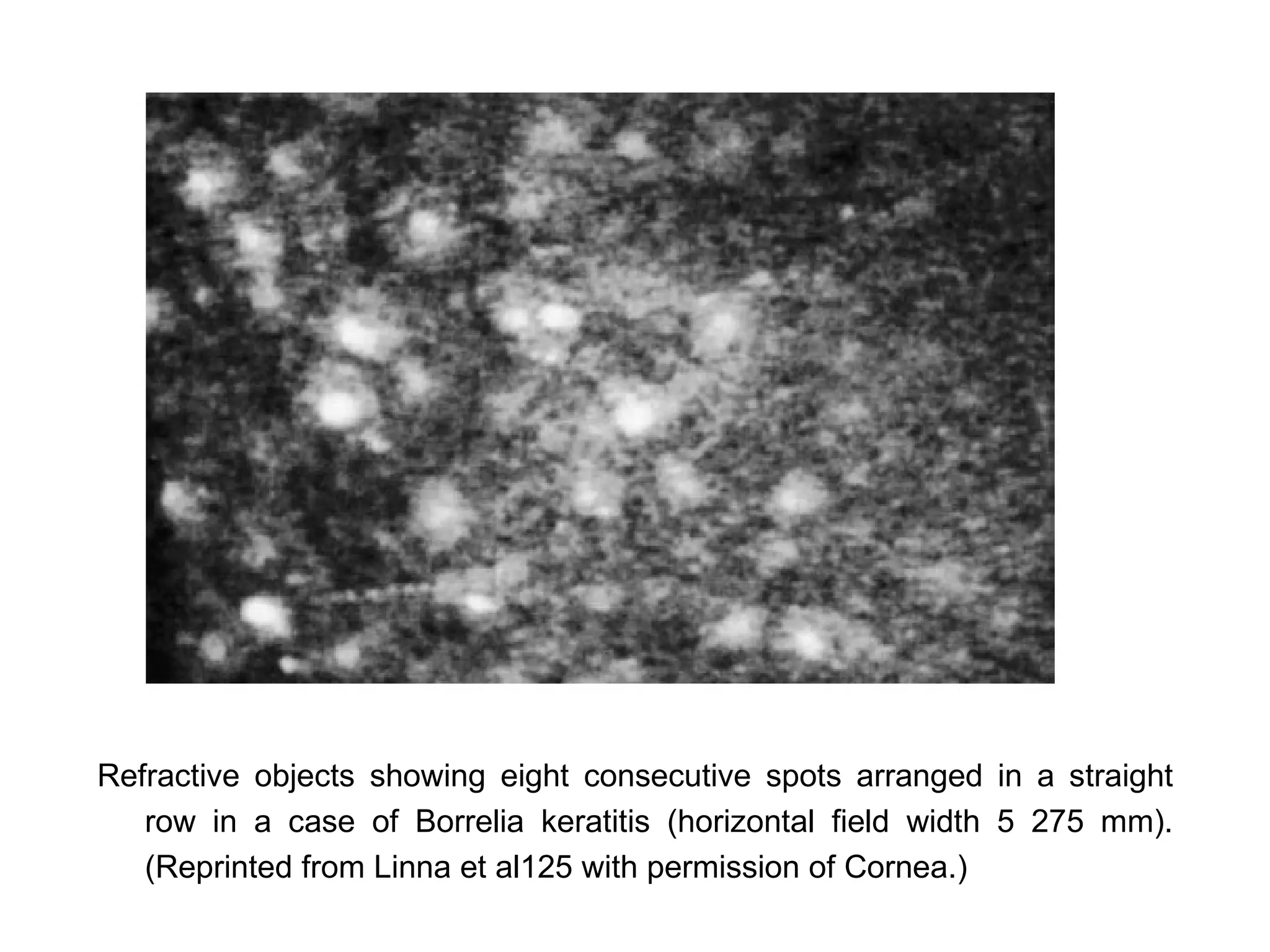 Refractive objects showing eight consecutive spots arranged in a straight
   row in a case of Borrelia keratitis (horizontal field width 5 275 mm).
   (Reprinted from Linna et al125 with permission of Cornea.)
 