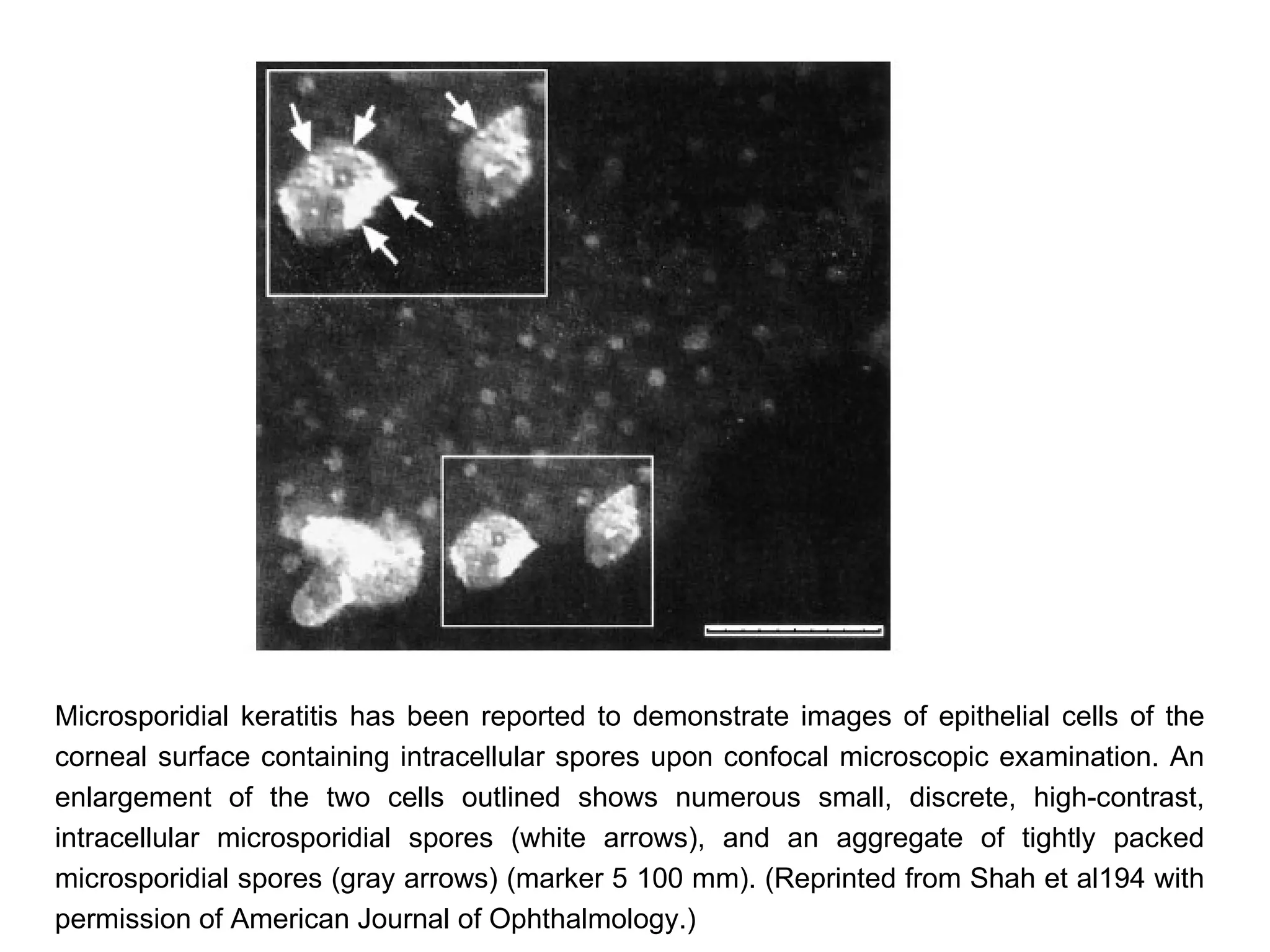 Microsporidial keratitis has been reported to demonstrate images of epithelial cells of the
corneal surface containing intracellular spores upon confocal microscopic examination. An
enlargement of the two cells outlined shows numerous small, discrete, high-contrast,
intracellular microsporidial spores (white arrows), and an aggregate of tightly packed
microsporidial spores (gray arrows) (marker 5 100 mm). (Reprinted from Shah et al194 with
permission of American Journal of Ophthalmology.)
 