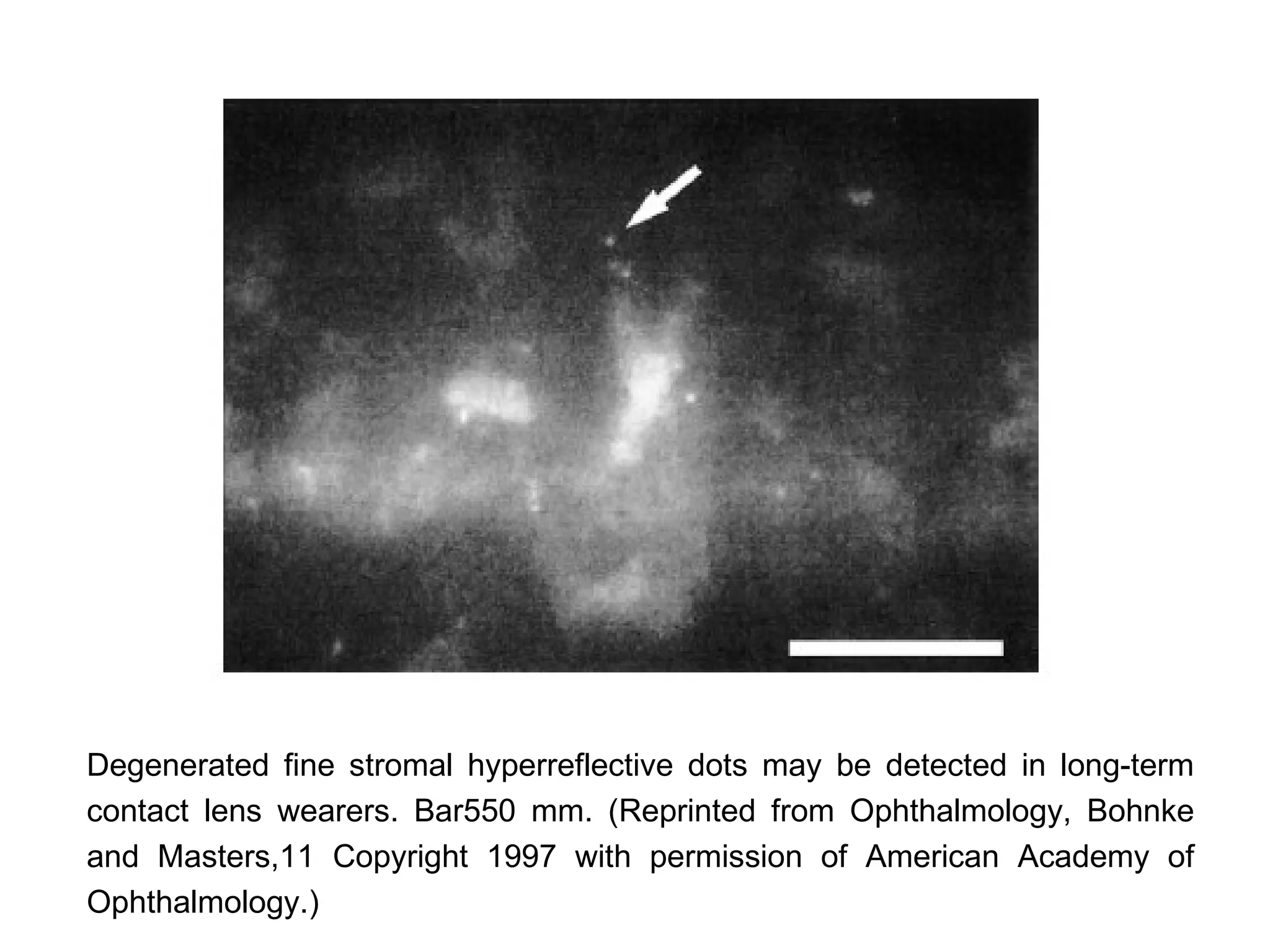 Degenerated fine stromal hyperreflective dots may be detected in long-term
contact lens wearers. Bar550 mm. (Reprinted from Ophthalmology, Bohnke
and Masters,11 Copyright 1997 with permission of American Academy of
Ophthalmology.)
 