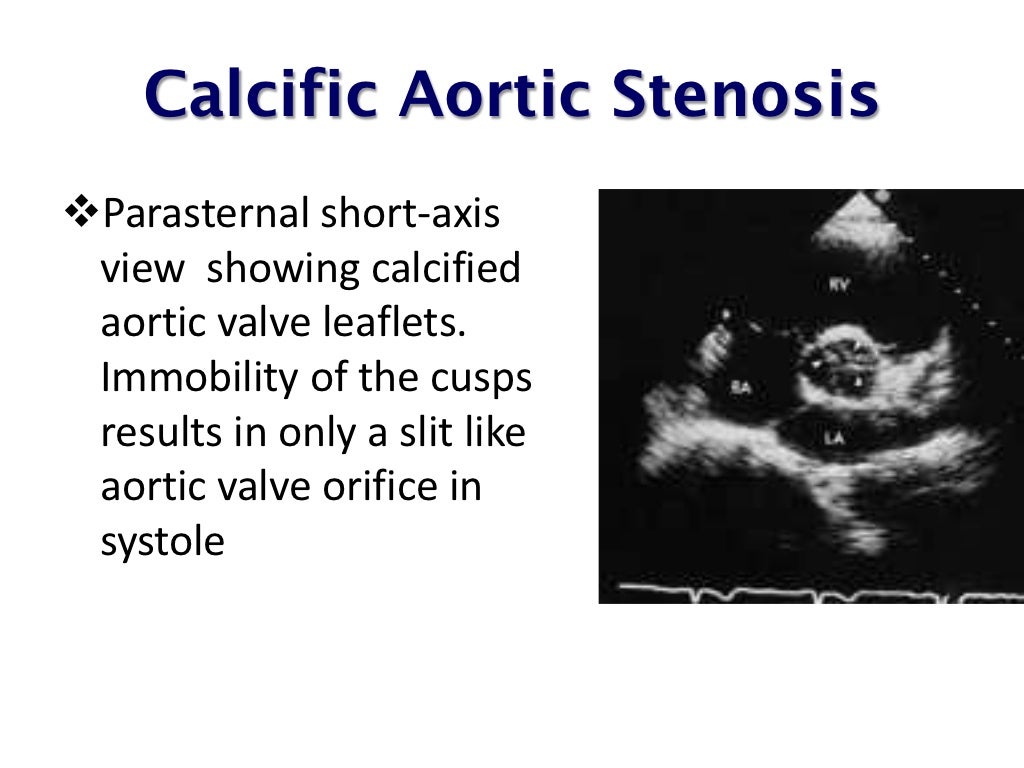 echo-assessment-of-aortic-stenosis