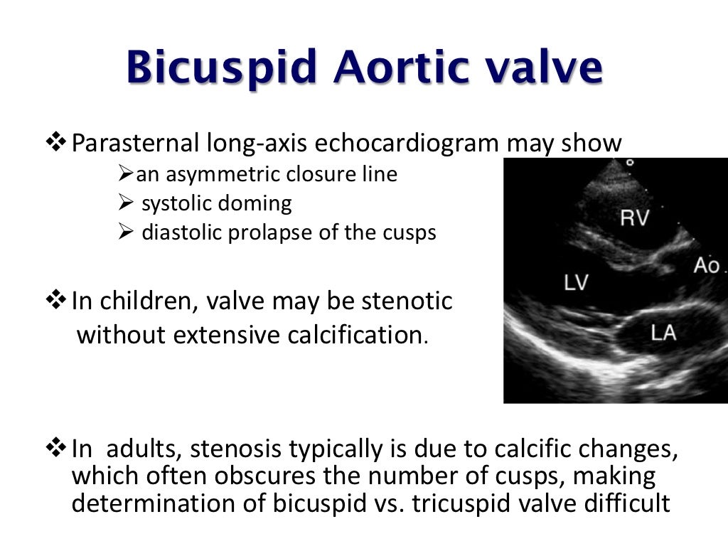 echo-assessment-of-aortic-stenosis
