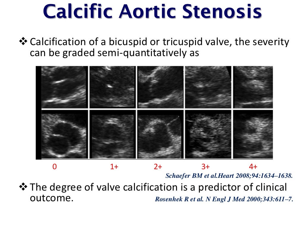 echo-assessment-of-aortic-stenosis