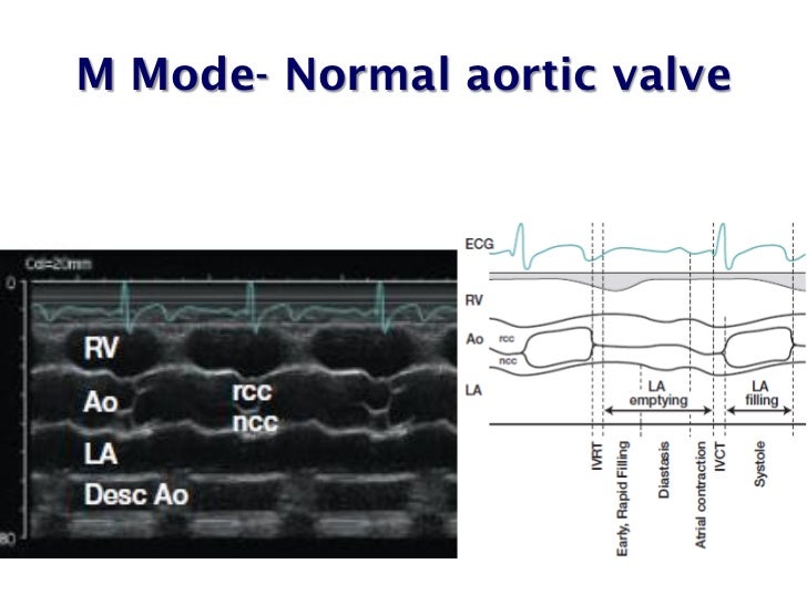 Echo assessment of Aortic Stenosis