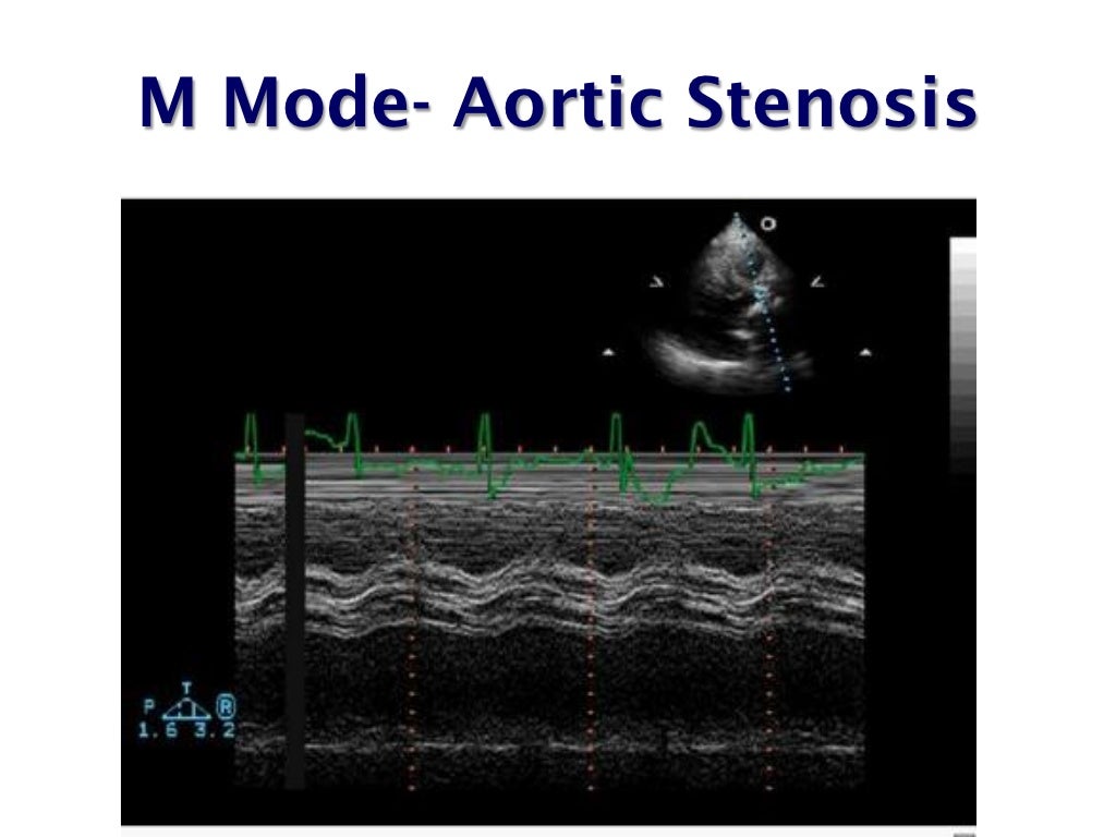 echo-assessment-of-aortic-stenosis