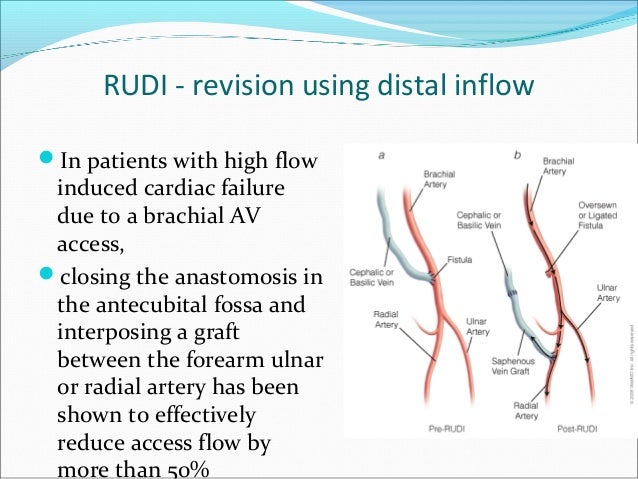 management of steal syndrome dr ravi bansal steal syndrome