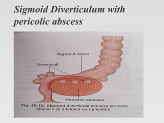 Pericholic Dr Ravi Kumar Meena Diverticulitis..pptx