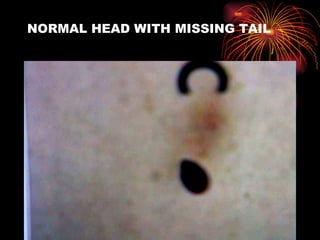 NORMAL HEAD WITH MISSING TAIL 