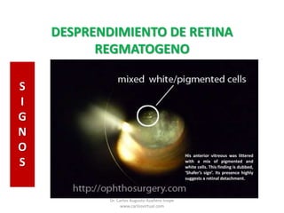Retina Mix DESPRENDIMIENTO DE RETINA REGMATOGENO | PPTX