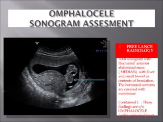     FREE LANCE
     RADIOLOGY

Fetal sonogram with
Herniated anterior
abdominal mass
( MEDIAN) with liver
and small bowel as
contents of herniation.
The herniated contents
are covered with
membrane

( contained ) . These
findings are s/o
OMPHALOCELE
( extra corporeal liver)
 