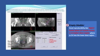 Empty bladder
Good reproducibility But Higher
bowel doses as rectum moves
in to higher dose region where
as SV into the lower dose region.
 