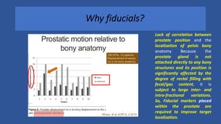 Why fiducials?
Lack of correlation between
prostate position and the
localization of pelvic bony
anatomy Because the
prostate gland is not
attached directly to any bony
structures and its position is
significantly affected by the
degree of rectal filling with
fecal/gas content, it is
subject to large inter- and
intra-fractional variations.
So, Fiducial markers placed
within the prostate are
required to improve target
localization.
 