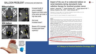 BALLOON PROBLEM?: INTRODUCING DEFORMATION
Increased length of
rectum irradiated?
Superior and inferior parts
of the rectum get closer to
high dose areas.
Anal canal:
Increased doses?
Beware of SV coverage;
Increase rectal doses
superiorly?
Without balloon
With balloon
A.T. Wong et al Practical Radiation Oncology, 2016
ImmobiLoc
Endorectal
ballon from
RadiaDyne
 