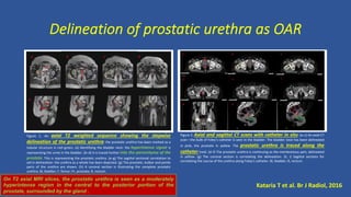 Delineation of prostatic urethra as OAR
Figure 1. An axial T2 weighted sequence showing the stepwise
delineation of the prostatic urethra: the prostatic urethra has been marked as a
tubular structure in red–green. (a) Identifying the bladder neck: the hyperintense signal is
representing the urine in the bladder. (b–d) It is traced further into the parenchyma of the
prostate. This is representing the prostatic urethra. (e–g) The sagittal sectional correlation to
aid in delineation: the urethra as a whole has been depicted. (g) The prostatic, bulbar and penile
parts of the urethra are shown. (h) A coronal section is illustrating the complete prostatic
urethra. Bl, bladder; F, femur; Pr, prostate; R, rectum.
Figure 2. Axial and sagittal CT scans with catheter in situ: (a–c) An axial CT
scan—the bulb of Foley’s catheter is seen in the bladder. The bladder neck has been delineated
in pink, the prostate in yellow. The prostatic urethra is traced along the
catheter (red). (d–f) The prostatic urethra is continuing as the membranous part, delineated
in yellow. (g) The coronal section is correlating the delineation. (h, i) Sagittal sections for
correlating the course of the urethra along Foley’s catheter. Bl, bladder; R, rectum.
Kataria T et al. Br J Radiol, 2016
On T2 axial MRI slices, the prostatic urethra is seen as a moderately
hyperintense region in the central to the posterior portion of the
prostate, surrounded by the gland .
 
