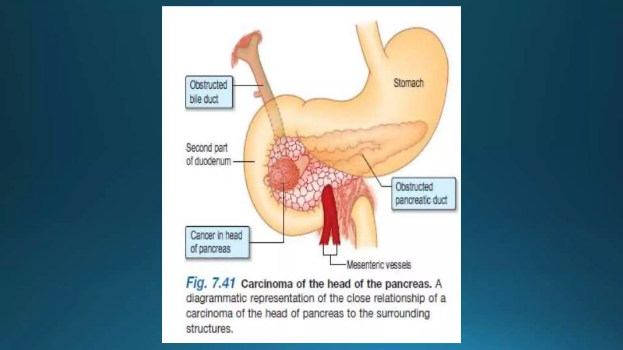 Pancreatic Cancer Malignant Obstructive Jaundice PPT pancreatic-cancer-malignant-obstructive-jaundice-ppt