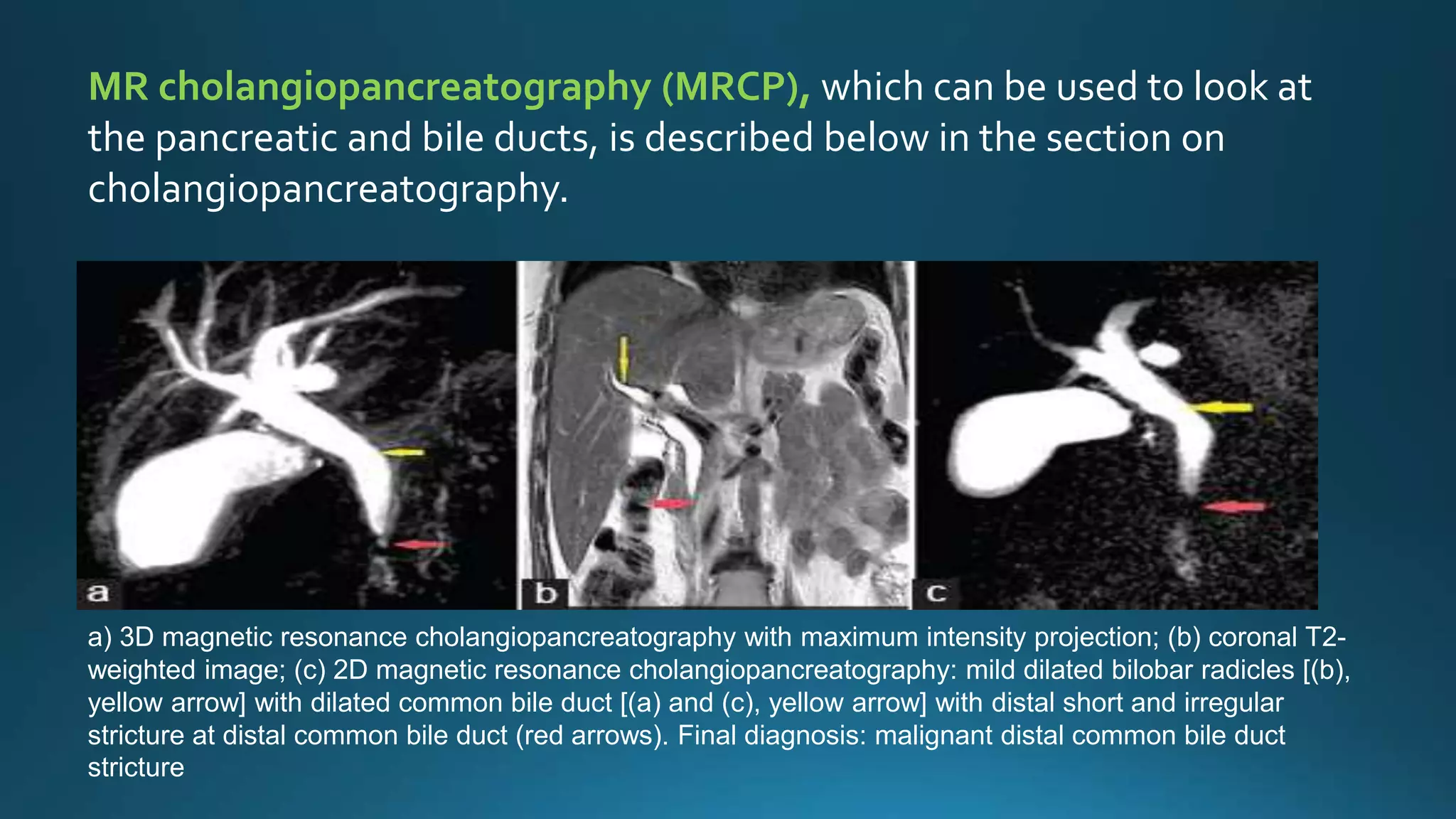 Pancreatic Cancer Malignant Obstructive Jaundice PPT pancreatic-cancer-malignant-obstructive-jaundice-ppt