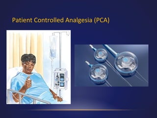 Patient Controlled Analgesia (PCA)

 