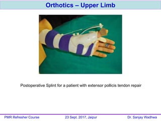 Orthotics – Upper Limb
PMR Refresher Course 23 Sept. 2017, Jaipur Dr. Sanjay Wadhwa
Postoperative Splint for a patient with extensor pollicis tendon repair
 