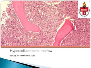Hypercellular Dr shashi bansal approch to bone marrow examination | PPTX