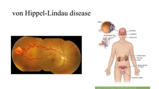 von Hippel-Lindau disease
 