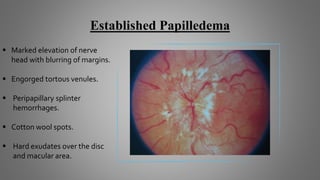 Established Papilledema
 Marked elevation of nerve
head with blurring of margins.
 Engorged tortous venules.
 Peripapillary splinter
hemorrhages.
 Cotton wool spots.
 Hard exudates over the disc
and macular area.
 