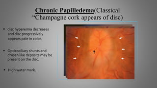 Chronic Papilledema(Classical
“Champagne cork appears of disc)
 disc hyperemia decreases
and disc progressively
appears pale in color.
 Opticociliary shunts and
drusen like deposits may be
present on the disc.
 High water mark.
 