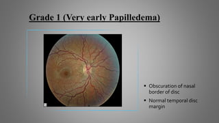 Grade 1 (Very early Papilledema)
 Obscuration of nasal
border of disc
 Normal temporal disc
margin
 