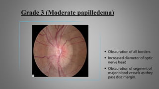 Grade 3 (Moderate papilledema)
 Obscuration of all borders
 Increased diameter of optic
nerve head
 Obscuration of segment of
major blood vessels as they
pass disc margin.
 