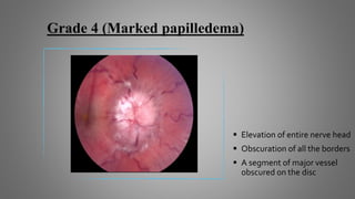 Grade 4 (Marked papilledema)
 Elevation of entire nerve head
 Obscuration of all the borders
 A segment of major vessel
obscured on the disc
 