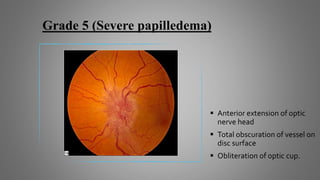 Grade 5 (Severe papilledema)
 Anterior extension of optic
nerve head
 Total obscuration of vessel on
disc surface
 Obliteration of optic cup.
 