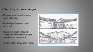  Sensory retinal changes
- Displacement of retina away
from optic disc.
- Buckling of the outer layers
of retina.
- Displacement of rods and
cones away from their anchor
near Bruch’s membrane.
- Serious RD in peripapillary area.
 