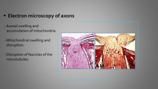  Electron microscopy of axons
- Axonal swelling and
accumulation of mitochondria.
- Mitochondrial swelling and
disruption.
- Disruption of fascicles of the
microtubules.
 