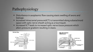 Pathophysiology
 Disturbance in axoplasmic flow causing stasis swelling of axons and
leakage.
 Increased intracranial pressure(ICT) is transmitted along subarachnoid
space with optic nerve sheath acting as a tourniquet.
 Increased ICT leads to increased optic nerve tissue pressure which
alters pressure gradient resulting in stasis.
 