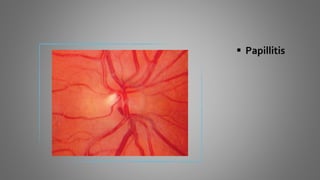  Papillitis
 