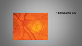  Tilted optic disc
 