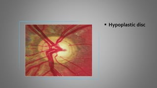  Hypoplastic disc
 