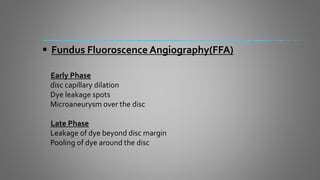 Fundus Fluoroscence Angiography(FFA)
Early Phase
disc capillary dilation
Dye leakage spots
Microaneurysm over the disc
Late Phase
Leakage of dye beyond disc margin
Pooling of dye around the disc
 