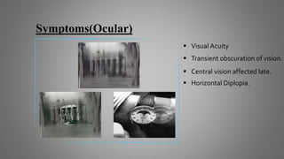 Symptoms(Ocular)
 Transient obscuration of vision.
 Central vision affected late.
 Horizontal Diplopia.
 Visual Acuity
 