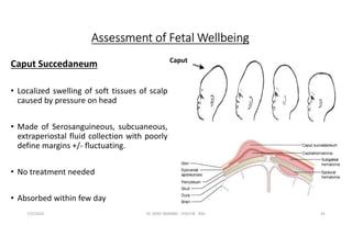 Dr Simo - Fetal Distress and Neonatal Asphyxia.pdf