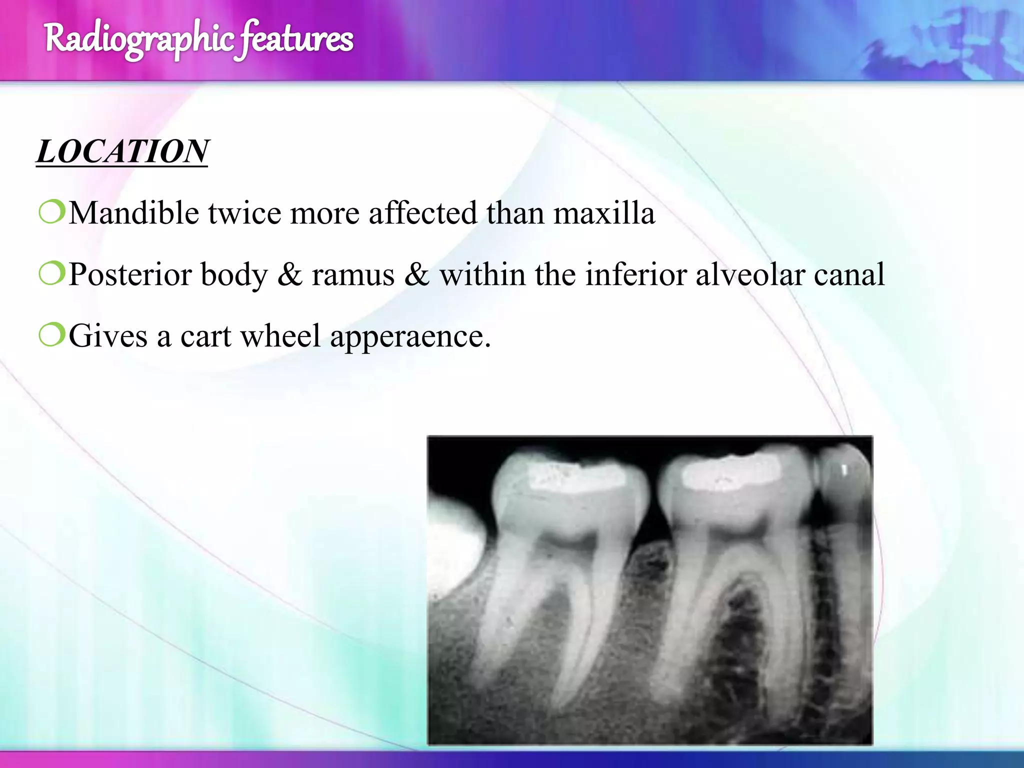 LOCATION
Mandible twice more affected than maxilla
Posterior body & ramus & within the inferior alveolar canal
Gives a cart wheel apperaence.
 