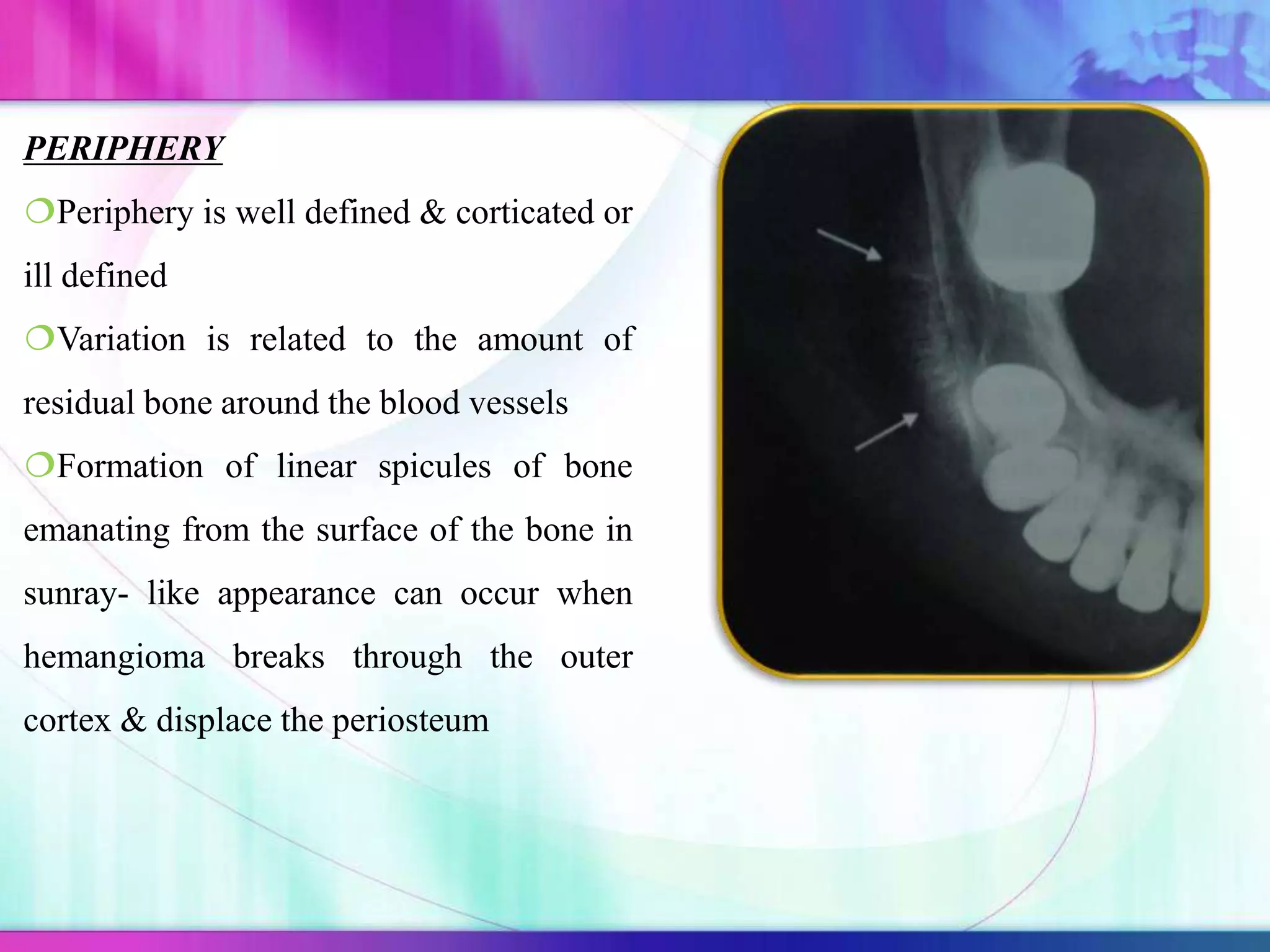 PERIPHERY
Periphery is well defined & corticated or
ill defined
Variation is related to the amount of
residual bone around the blood vessels
Formation of linear spicules of bone
emanating from the surface of the bone in
sunray- like appearance can occur when
hemangioma breaks through the outer
cortex & displace the periosteum
 