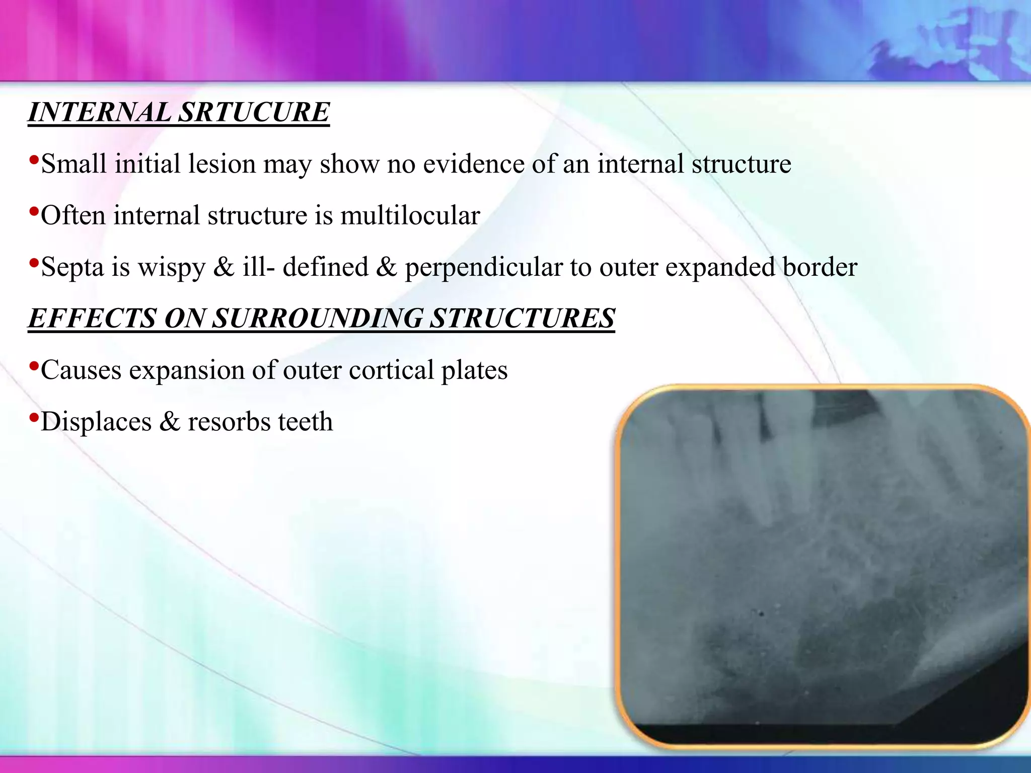 INTERNAL SRTUCURE
•Small initial lesion may show no evidence of an internal structure
•Often internal structure is multilocular
•Septa is wispy & ill- defined & perpendicular to outer expanded border
EFFECTS ON SURROUNDING STRUCTURES
•Causes expansion of outer cortical plates
•Displaces & resorbs teeth
 