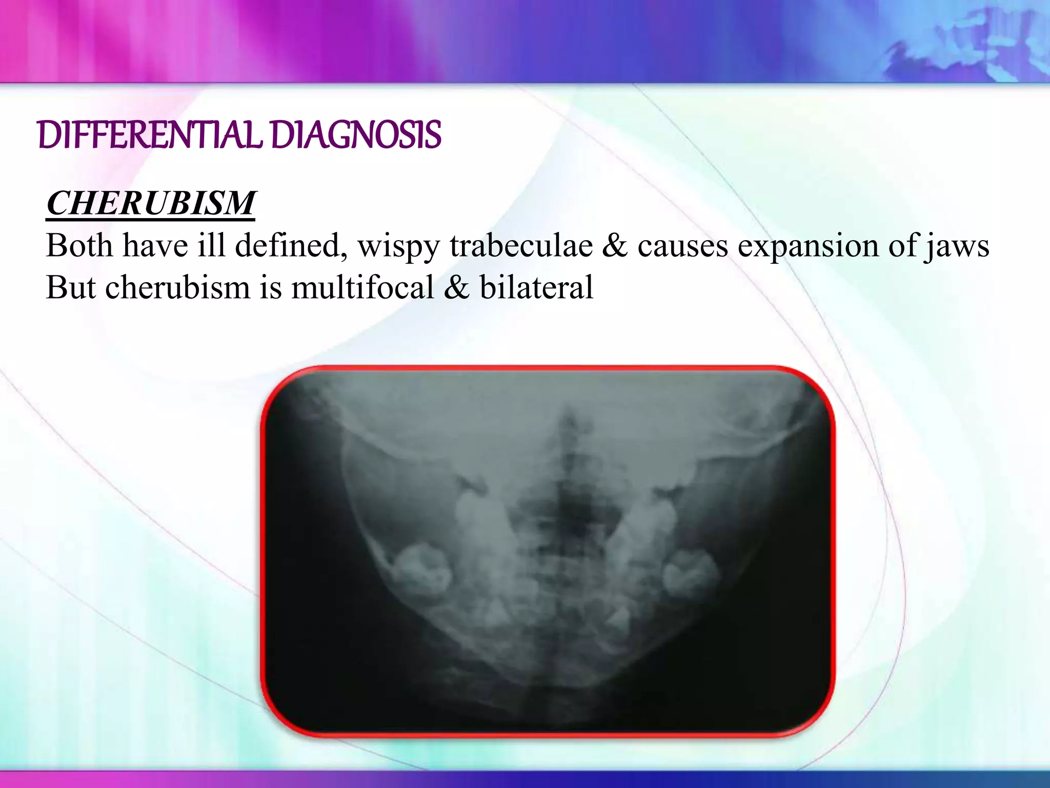 CHERUBISM
Both have ill defined, wispy trabeculae & causes expansion of jaws
But cherubism is multifocal & bilateral
DIFFERENTIALDIAGNOSIS
 