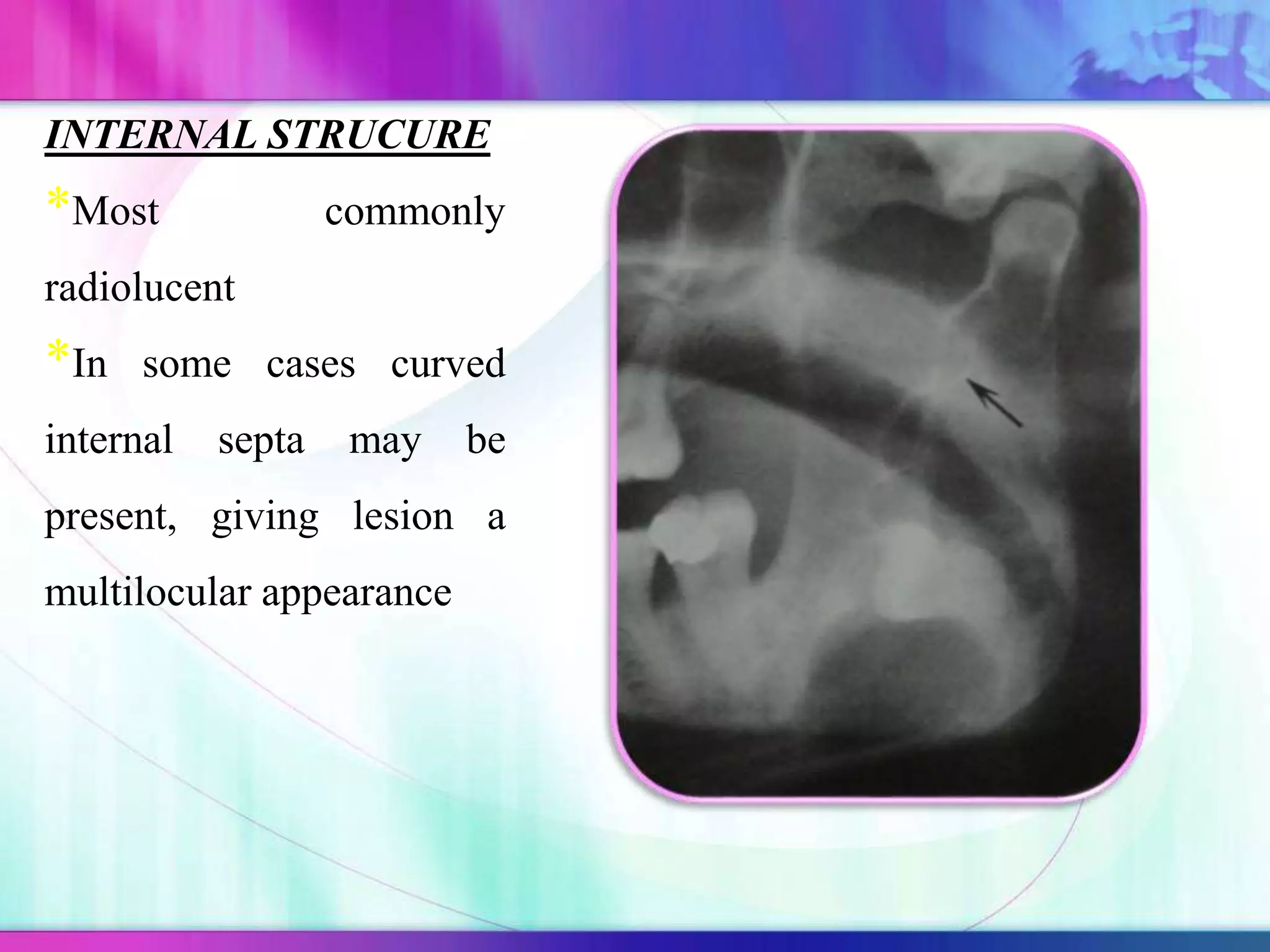 INTERNAL STRUCURE
*Most commonly
radiolucent
*In some cases curved
internal septa may be
present, giving lesion a
multilocular appearance
 