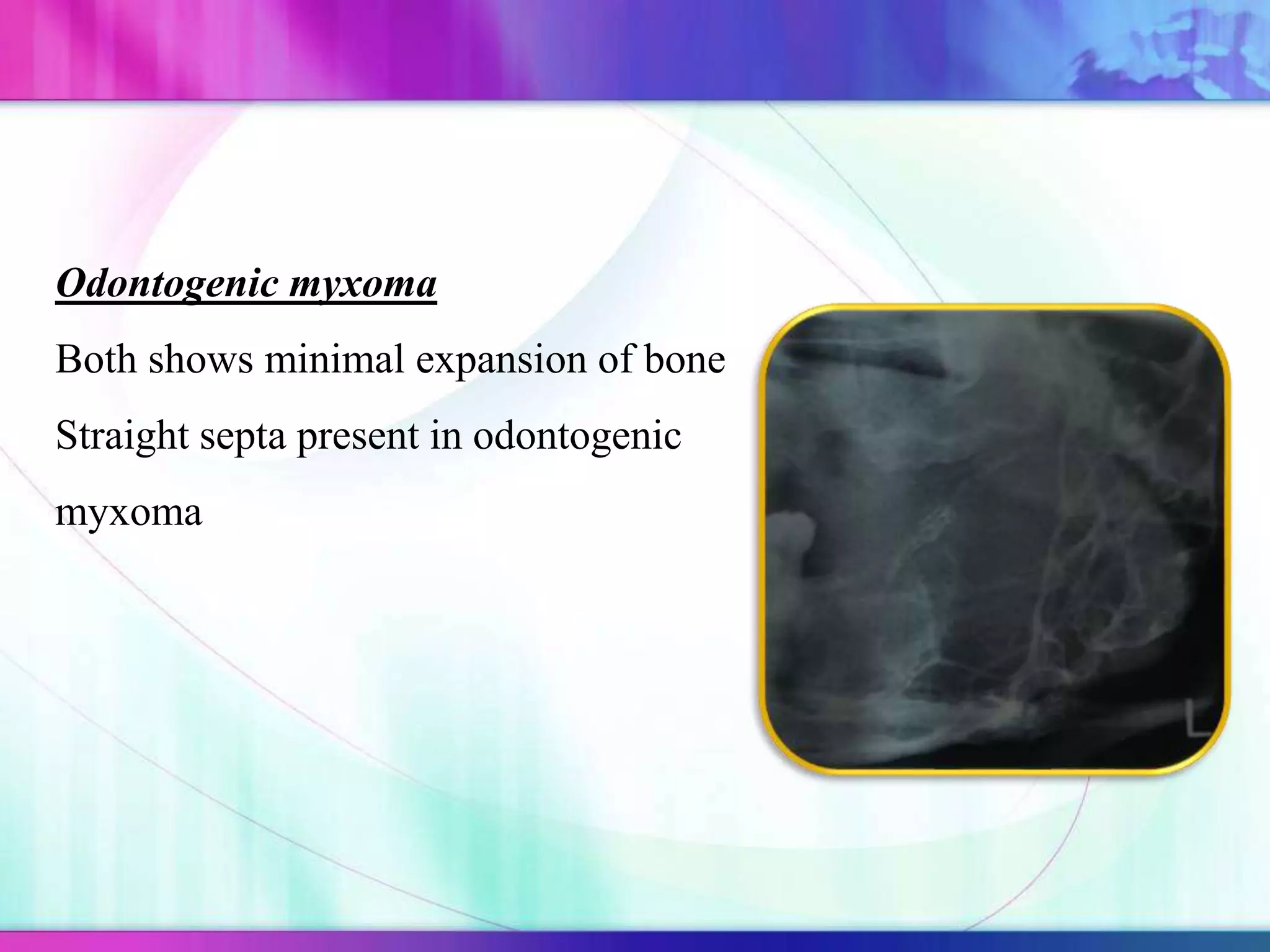 Odontogenic myxoma
Both shows minimal expansion of bone
Straight septa present in odontogenic
myxoma
 