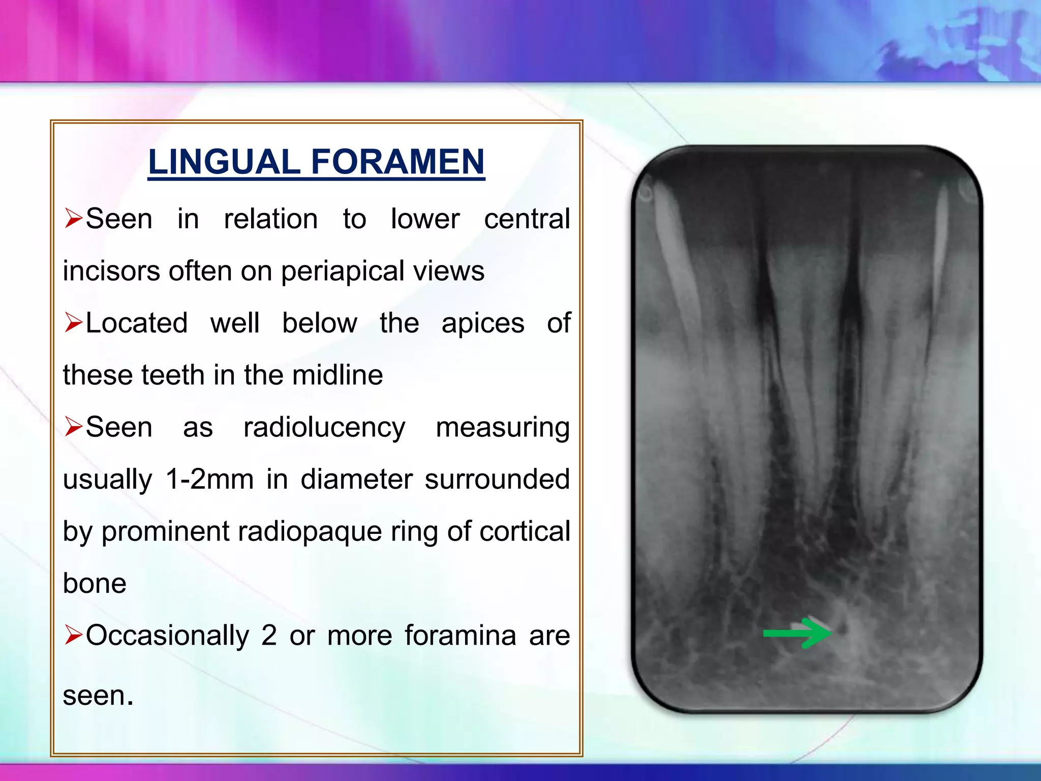 LINGUAL FORAMEN
Seen in relation to lower central
incisors often on periapical views
Located well below the apices of
these teeth in the midline
Seen as radiolucency measuring
usually 1-2mm in diameter surrounded
by prominent radiopaque ring of cortical
bone
Occasionally 2 or more foramina are
seen.
 