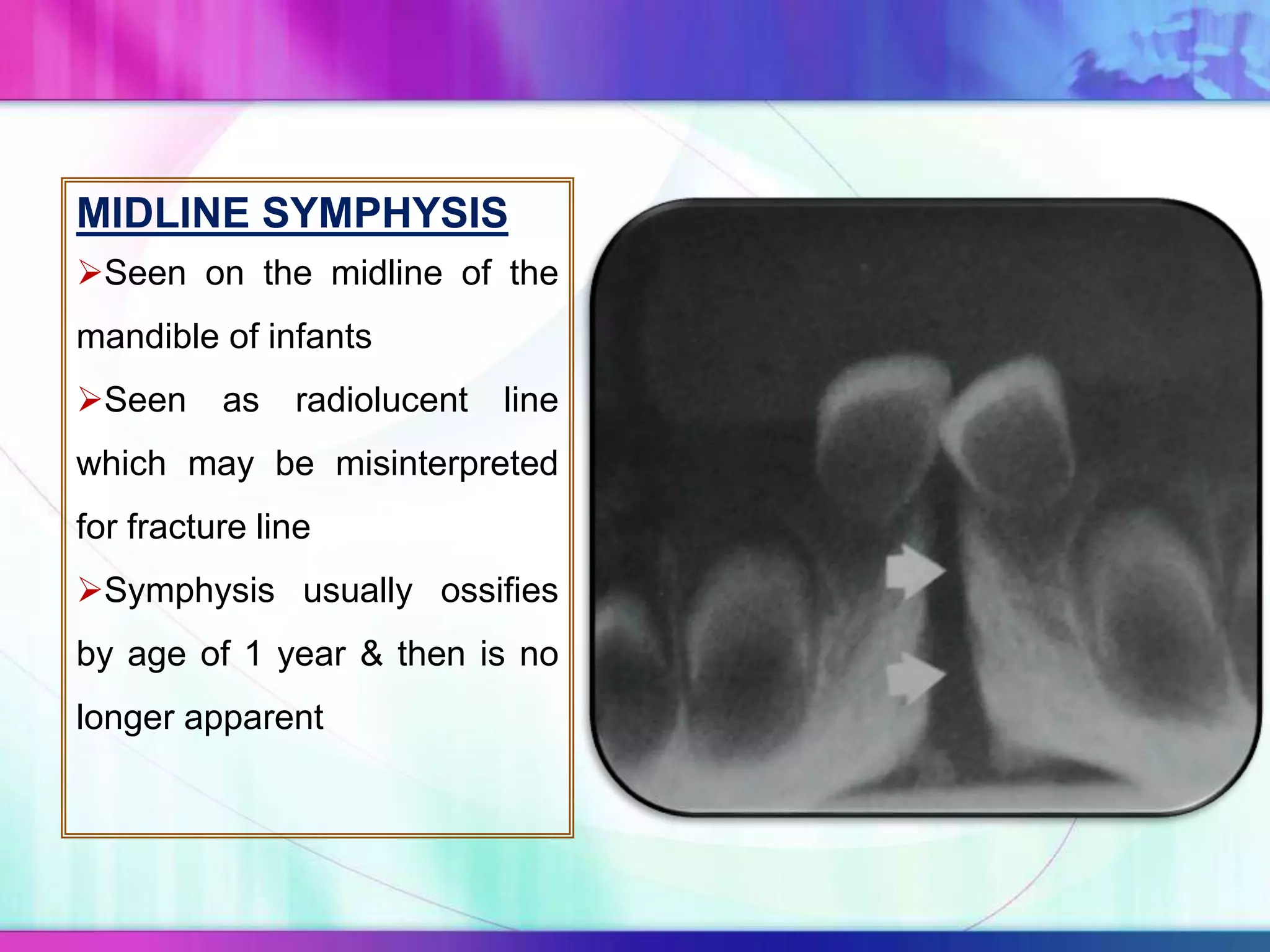 MIDLINE SYMPHYSIS
Seen on the midline of the
mandible of infants
Seen as radiolucent line
which may be misinterpreted
for fracture line
Symphysis usually ossifies
by age of 1 year & then is no
longer apparent
 