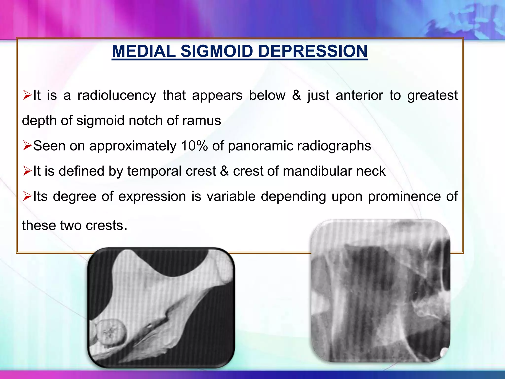 MEDIAL SIGMOID DEPRESSION
It is a radiolucency that appears below & just anterior to greatest
depth of sigmoid notch of ramus
Seen on approximately 10% of panoramic radiographs
It is defined by temporal crest & crest of mandibular neck
Its degree of expression is variable depending upon prominence of
these two crests.
 