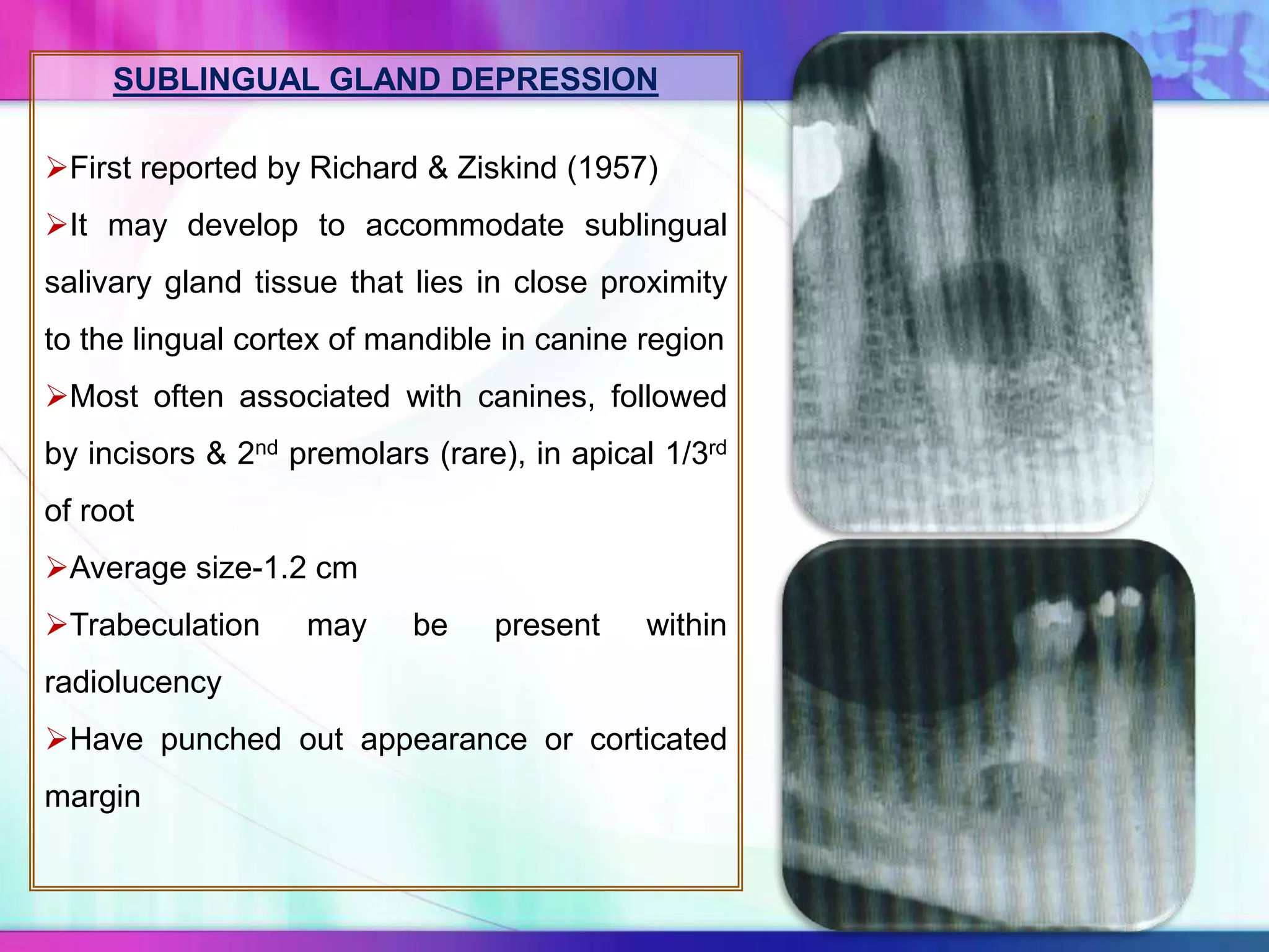 SUBLINGUAL GLAND DEPRESSION
First reported by Richard & Ziskind (1957)
It may develop to accommodate sublingual
salivary gland tissue that lies in close proximity
to the lingual cortex of mandible in canine region
Most often associated with canines, followed
by incisors & 2nd premolars (rare), in apical 1/3rd
of root
Average size-1.2 cm
Trabeculation may be present within
radiolucency
Have punched out appearance or corticated
margin
 