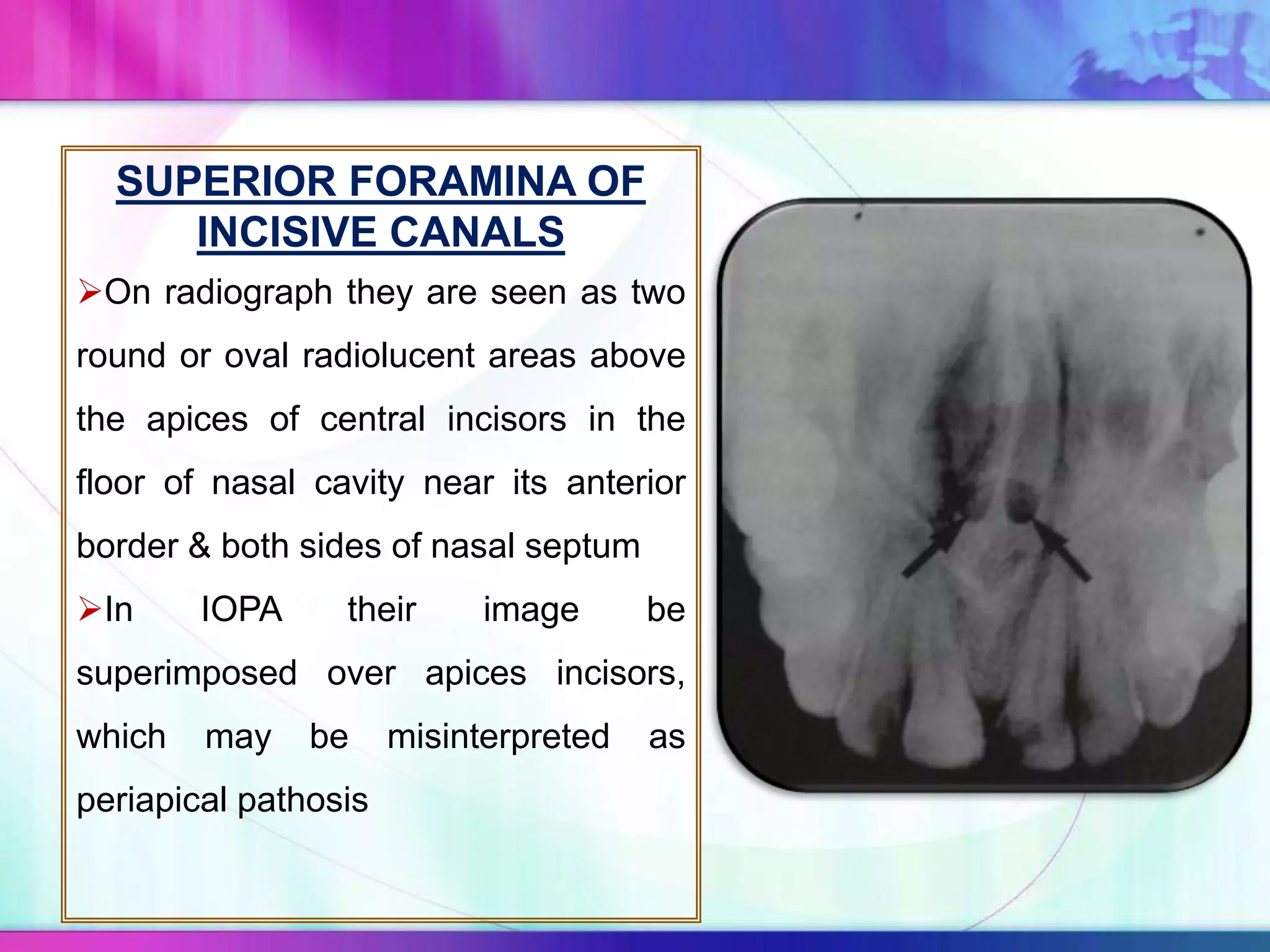 SUPERIOR FORAMINA OF
INCISIVE CANALS
On radiograph they are seen as two
round or oval radiolucent areas above
the apices of central incisors in the
floor of nasal cavity near its anterior
border & both sides of nasal septum
In IOPA their image be
superimposed over apices incisors,
which may be misinterpreted as
periapical pathosis
 