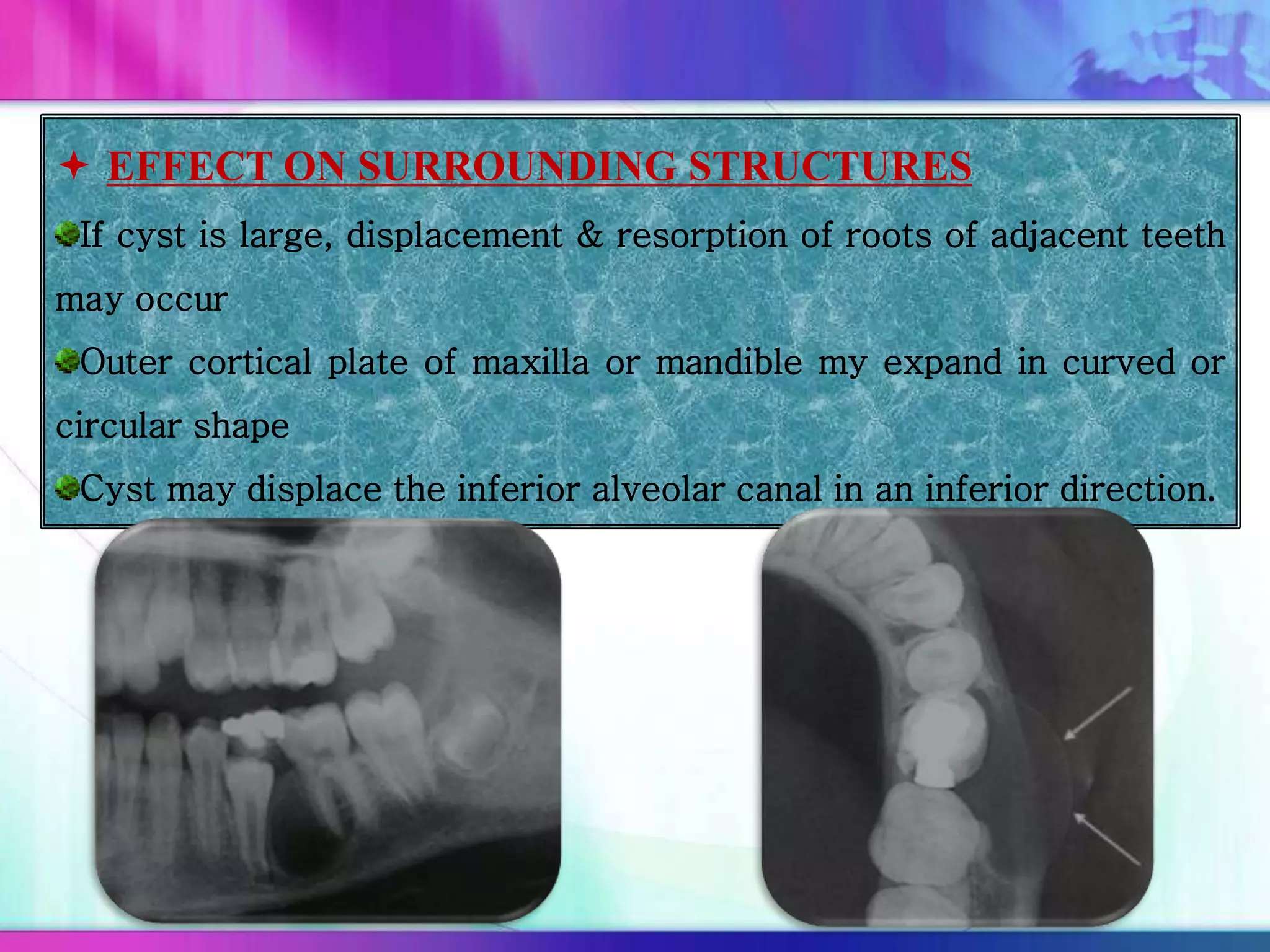  EFFECT ON SURROUNDING STRUCTURES
If cyst is large, displacement & resorption of roots of adjacent teeth
may occur
Outer cortical plate of maxilla or mandible my expand in curved or
circular shape
Cyst may displace the inferior alveolar canal in an inferior direction.
 